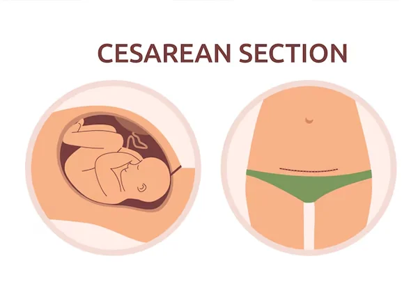 Caesarean Section