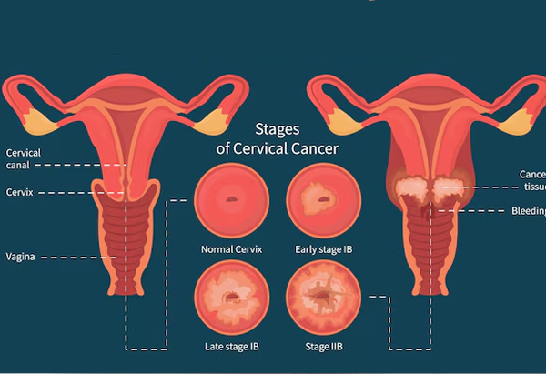 Cervical Encerclage