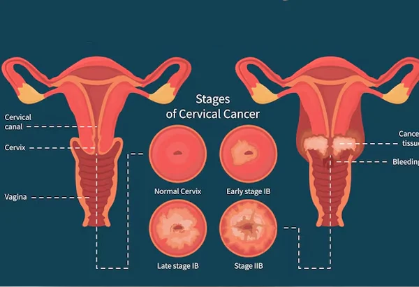 Cervical Encerclage