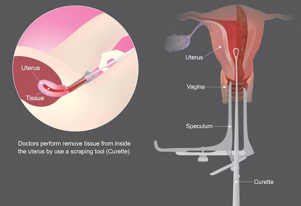 Dilatation and Curettage