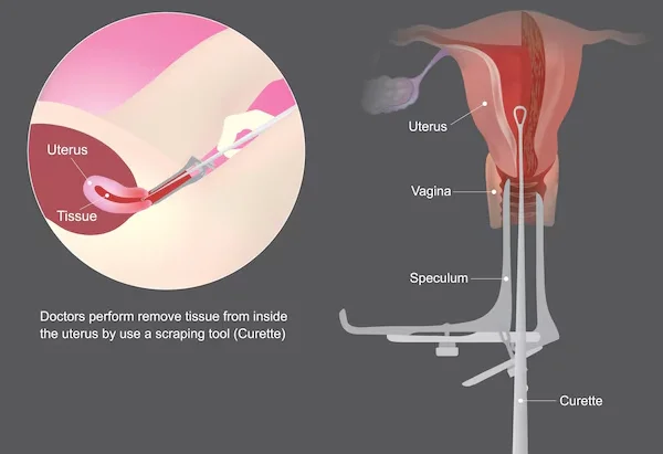 Dilatation and Curettage