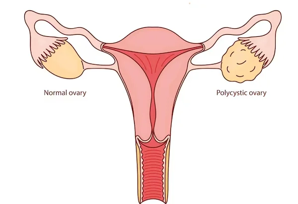 PCOD, PCOS And Menstrual Disorders